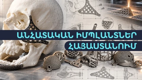 Հայաստանում ստեղծում են անհատականացված իմպլանտներ. ինչպե՞ս
