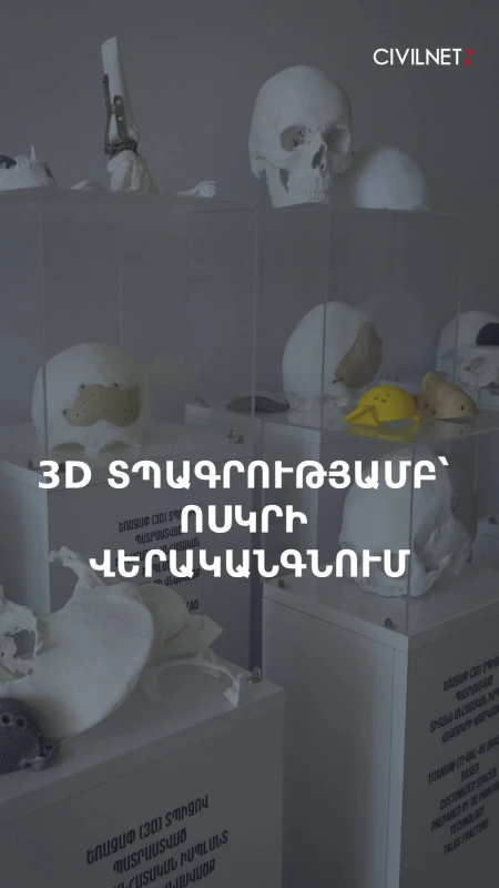 AIP Tech-ը ստեղծում է անհատական իմպլանտներ