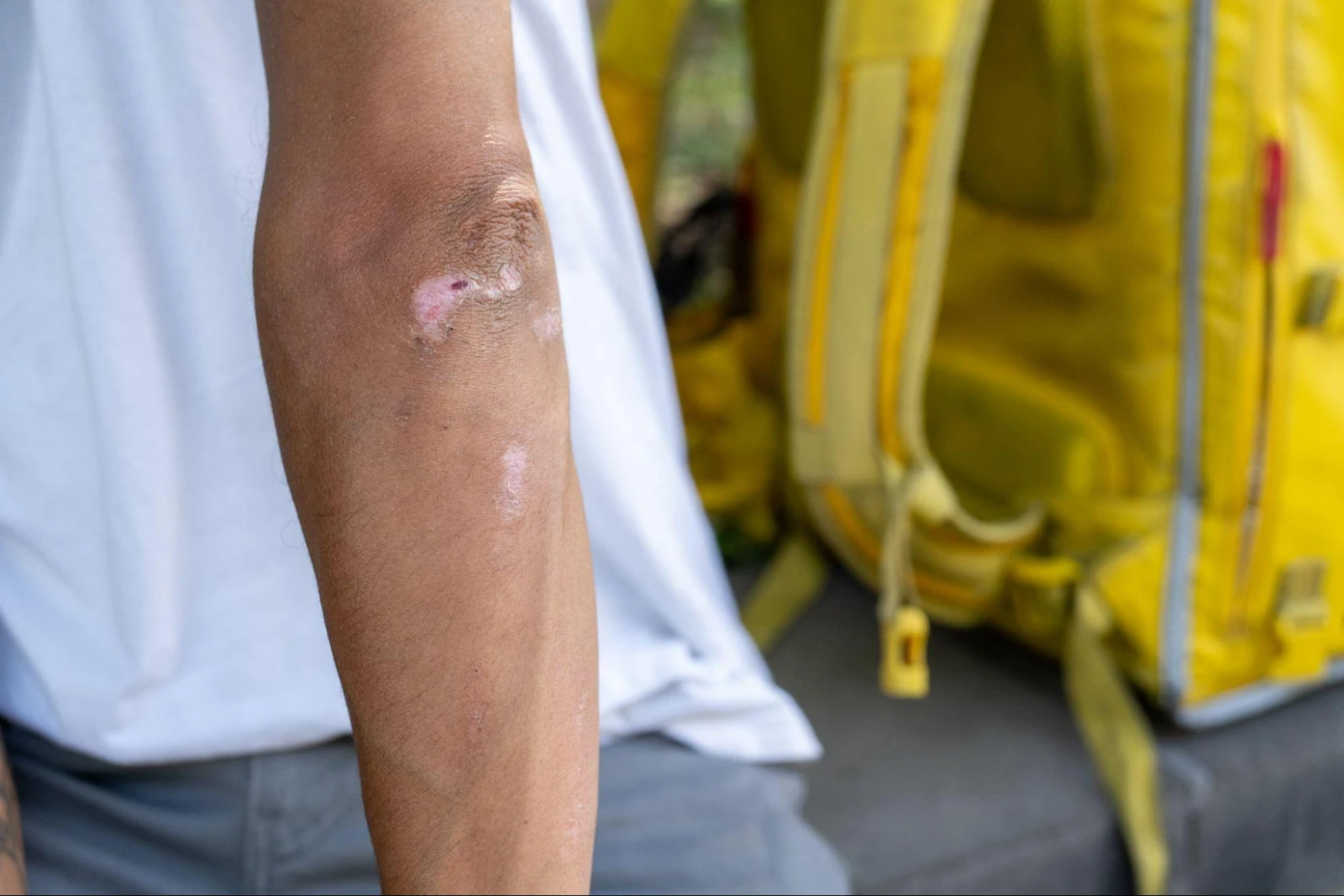 The lasting injuries from Mohamed’s most recent accident 
